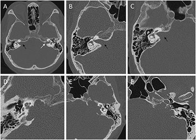 Risk Factors for Progression in Vestibular Schwannomas After Incomplete Resection: A Single Center Retrospective Study